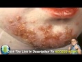 The Symptoms Of Impetigo And How To Treat Each Impetigo Symptom